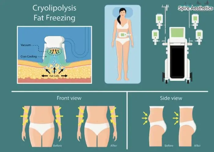 Fat freezing treatment Dorchester benefits for competitions to remove stubborn fat deposits.