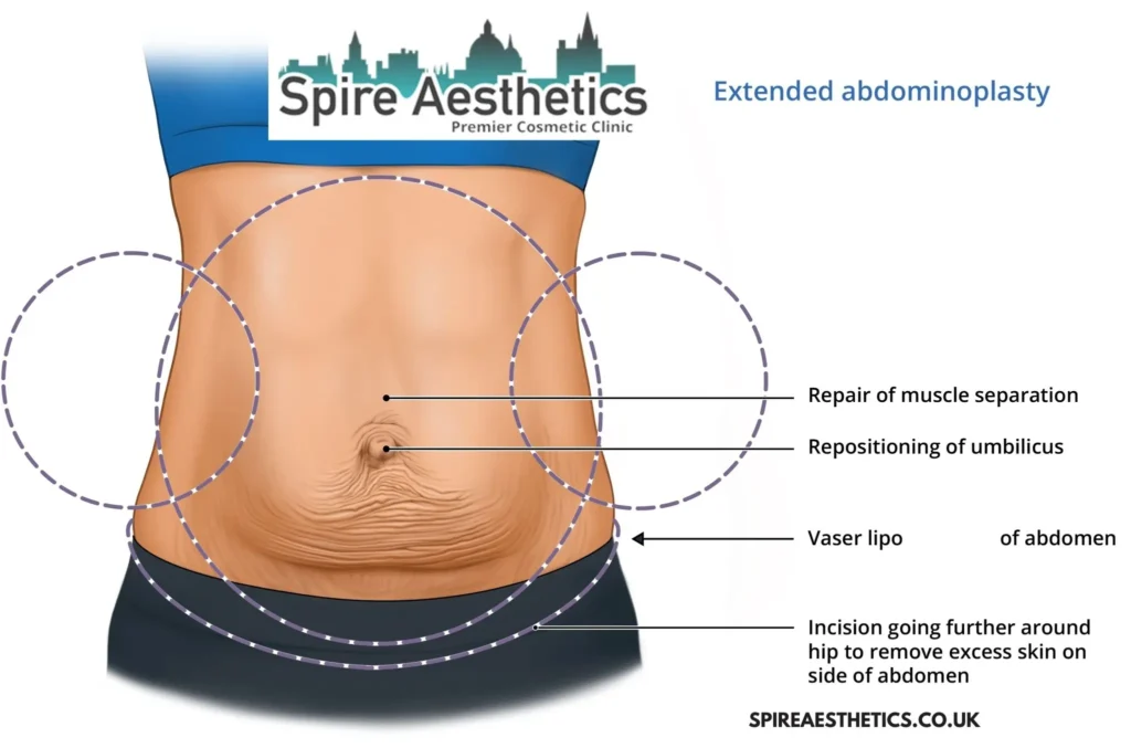 Understanding Loose Skin After Gastric Band Dorchester Surgery and HIFU Treatment