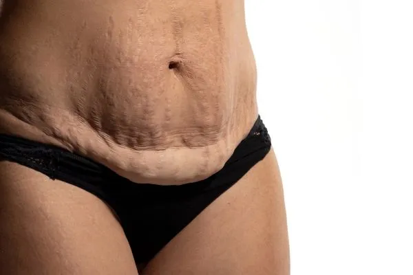 Image of womans stomach after weight loss injections Dorchester showing saggy skin