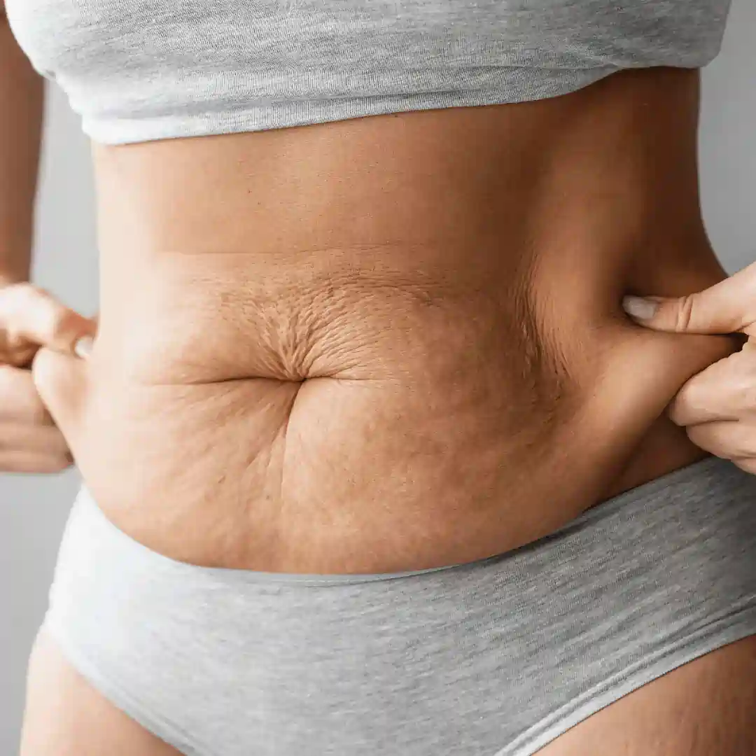 Is It Normal to Have Loose Skin After Pregnancy Dorchester?
